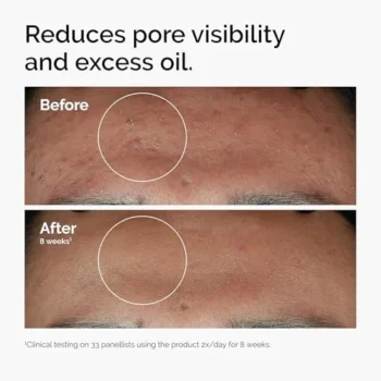 The Ordinary Niacinamide 10% + Zinc 1% Serum Review: The Ultimate Test for Blemish-Prone Skin