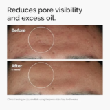 The Ordinary Niacinamide 10% + Zinc 1% Serum Review: The Ultimate Test for Blemish-Prone Skin